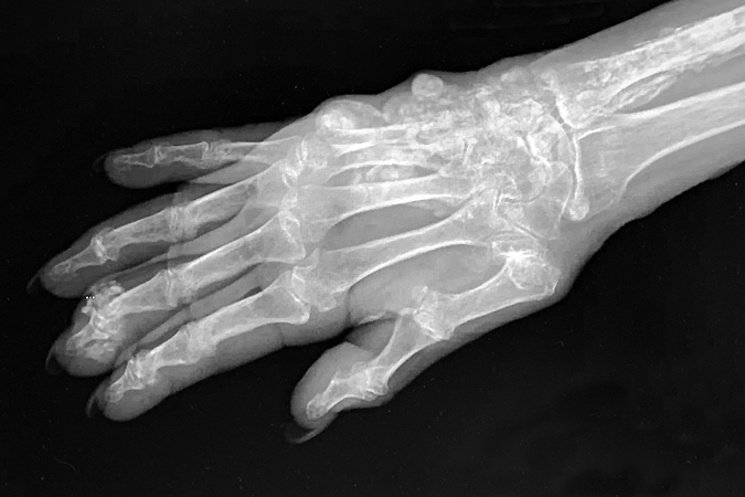 SCLERODERMA SYSTEMIC SCLEROSIS CREST Hand Surgery Resource scleroderma-systemic-sclerosis-crest-hand-surgery-resource